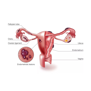 Лечение эндометриоза в Воронеже