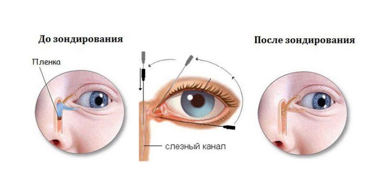 Схема массажа слезного канала у новорожденных